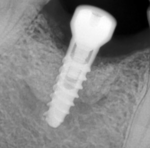 odbudowa Zęba implantem 