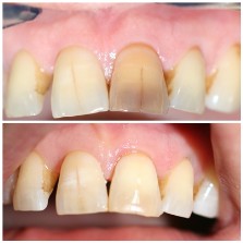 wybielanie zęba po leczeniu kanałowym